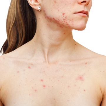 Acne behandeling