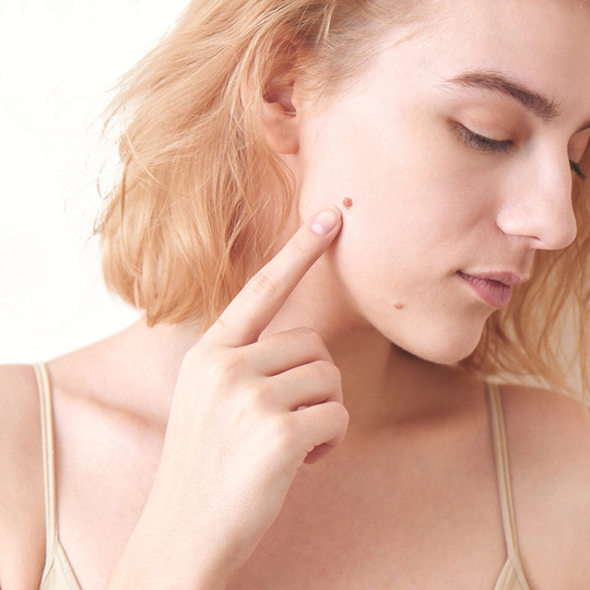 Acne behandeling