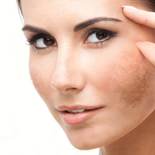 Acne behandeling