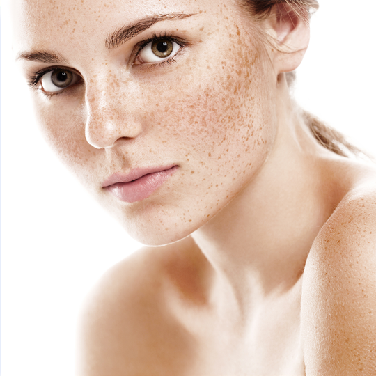 Acne behandeling