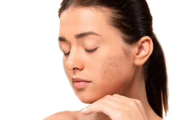 Acne behandeling