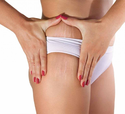 Acne behandeling